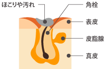 ニキビ図解